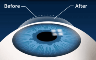 ما هي أفضل جراحة تصحيحية للعين 2022؟