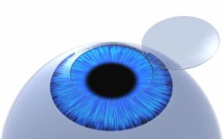 سعر عملية الليزك 2023 بالتفصيل