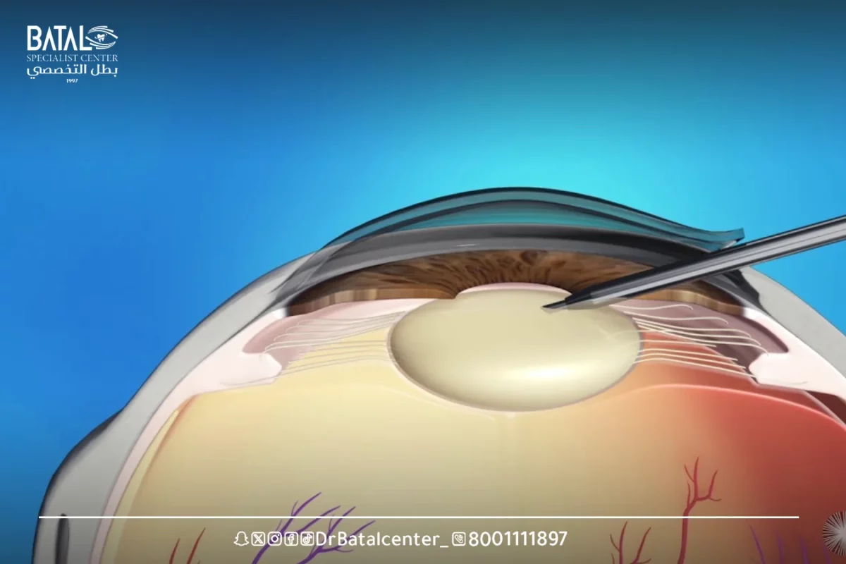 كم يستغرق التعافي من عملية سحب الماء من العين؟