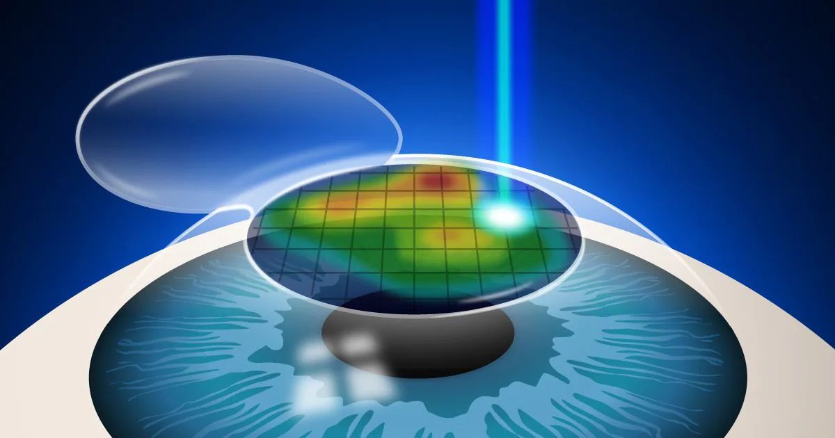 عملية الليزك