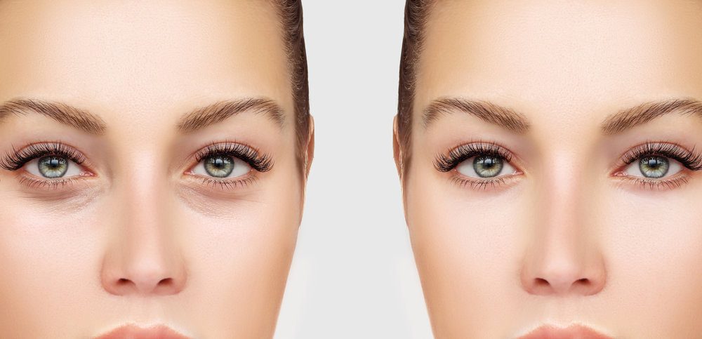 إجراء شد الجفون السفلية