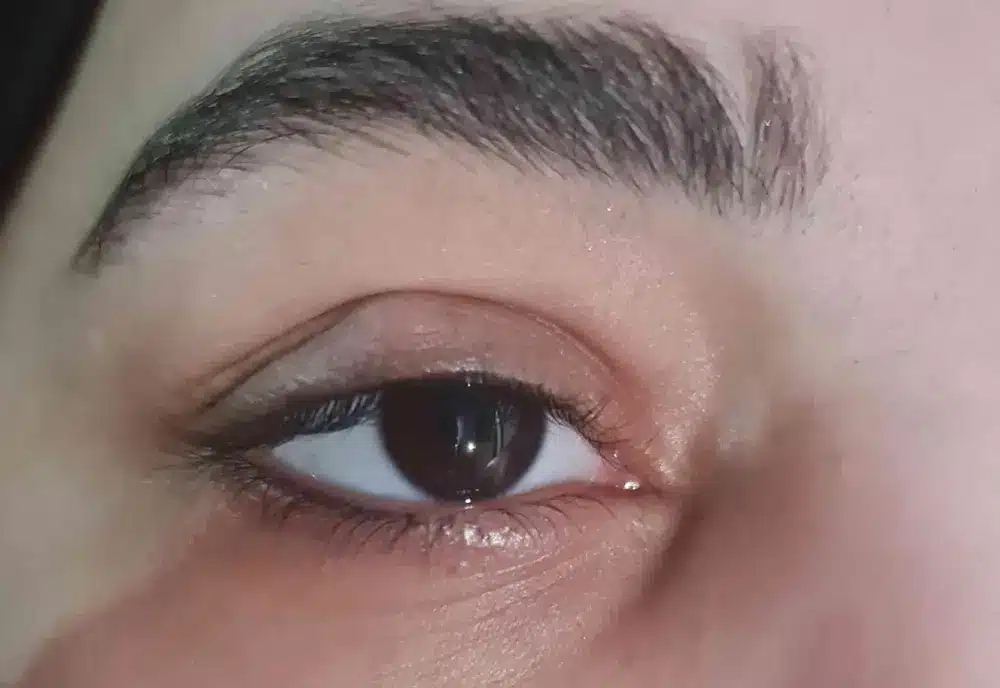 علاج كيس دهني بالعين عند الطبيب