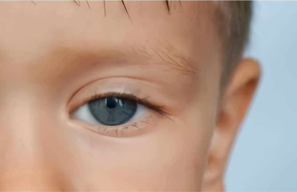 ارتخاء الجفون عند الأطفال والبالغين | الأسباب والعلاج