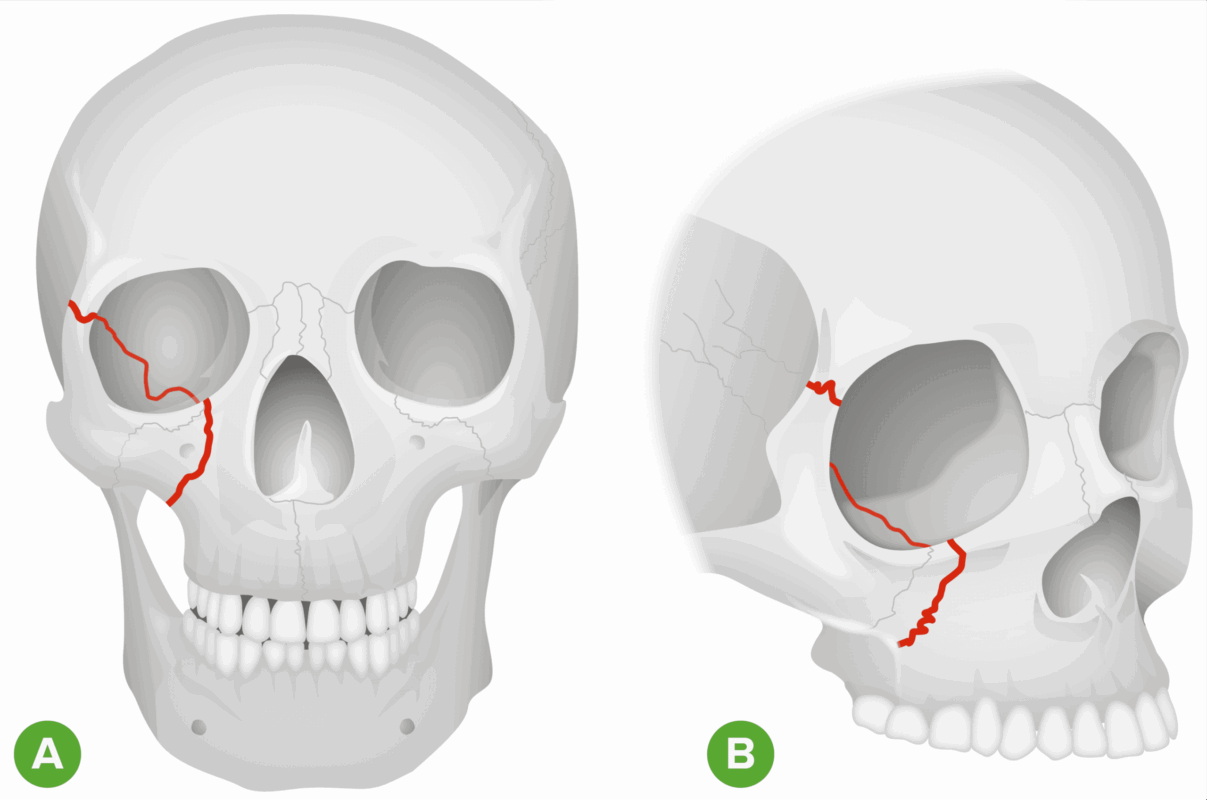 كسر الحجاج المداري