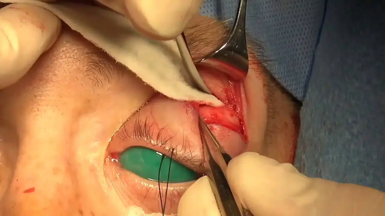 ورم الغدة الدمعية