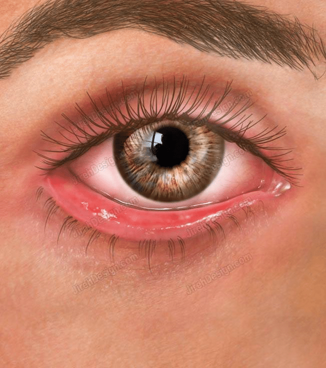 البرشور في العين