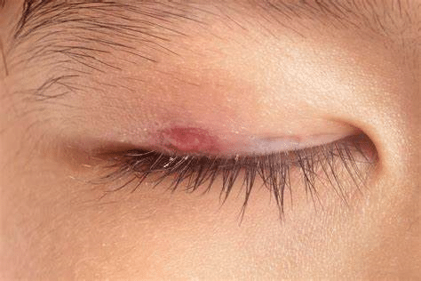 التهاب الجفن الحرشفية