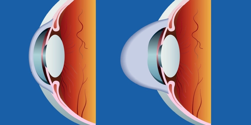 Family History of Keratoconus
