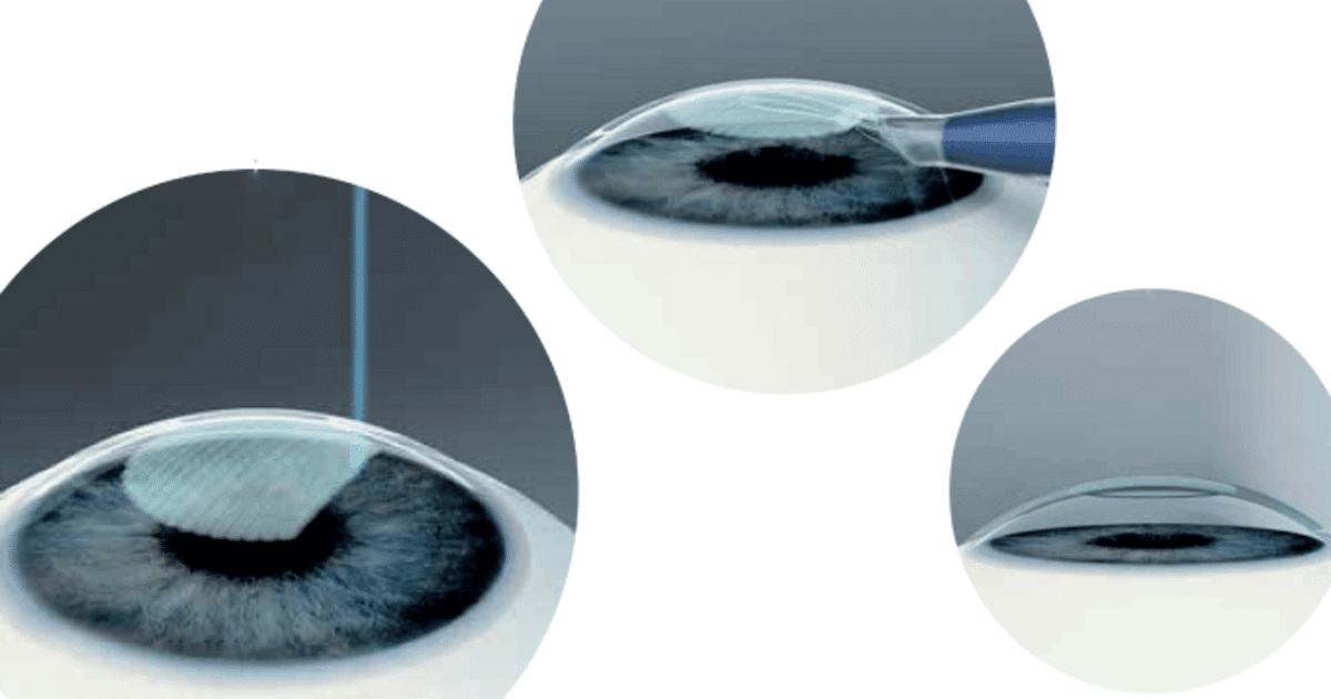 علاج القرنية المخروطية