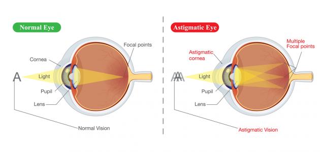  انحراف القرنية في العين