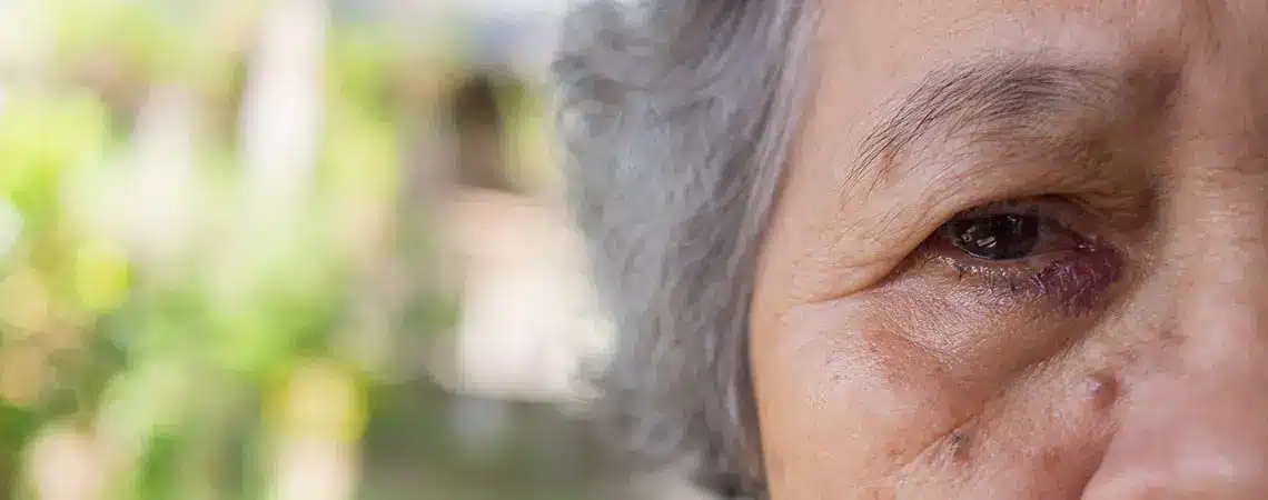 التهاب كيس الدمع