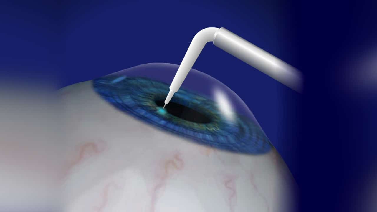 عملية تجميل القرنية