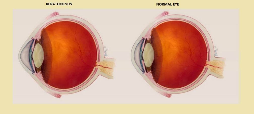 عملية تصحيح النظر للقرنية المخروطية 