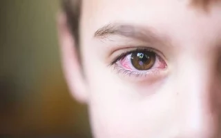 التهاب العين عند الاطفال: كيف تحمي طفلك؟ 2024