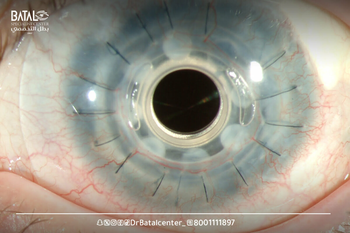 تجربتي مع عملية زراعة القرنية بالمراحل 2024