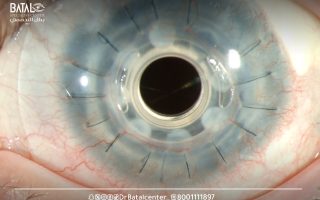 تجربتي مع عملية زراعة القرنية بالمراحل 2024