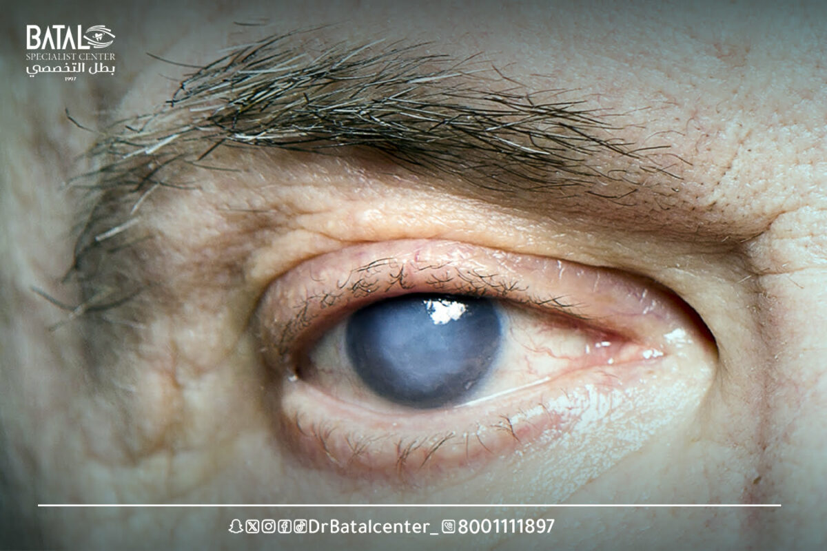 الجلوكوما: سارق البصر في صمت