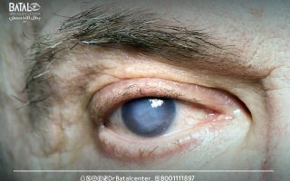 الجلوكوما: سارق البصر في صمت