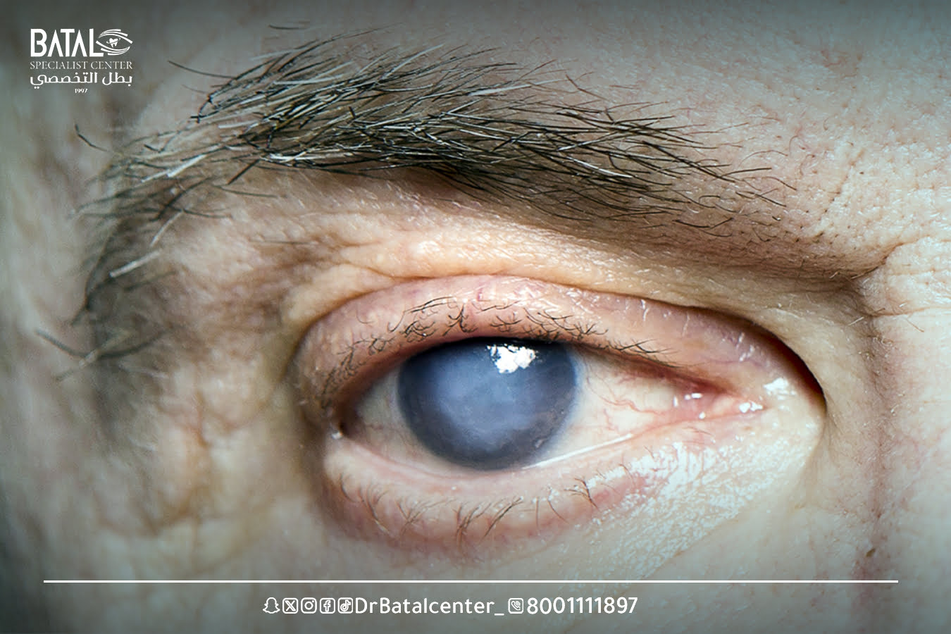 الجلوكوما: سارق البصر في صمت