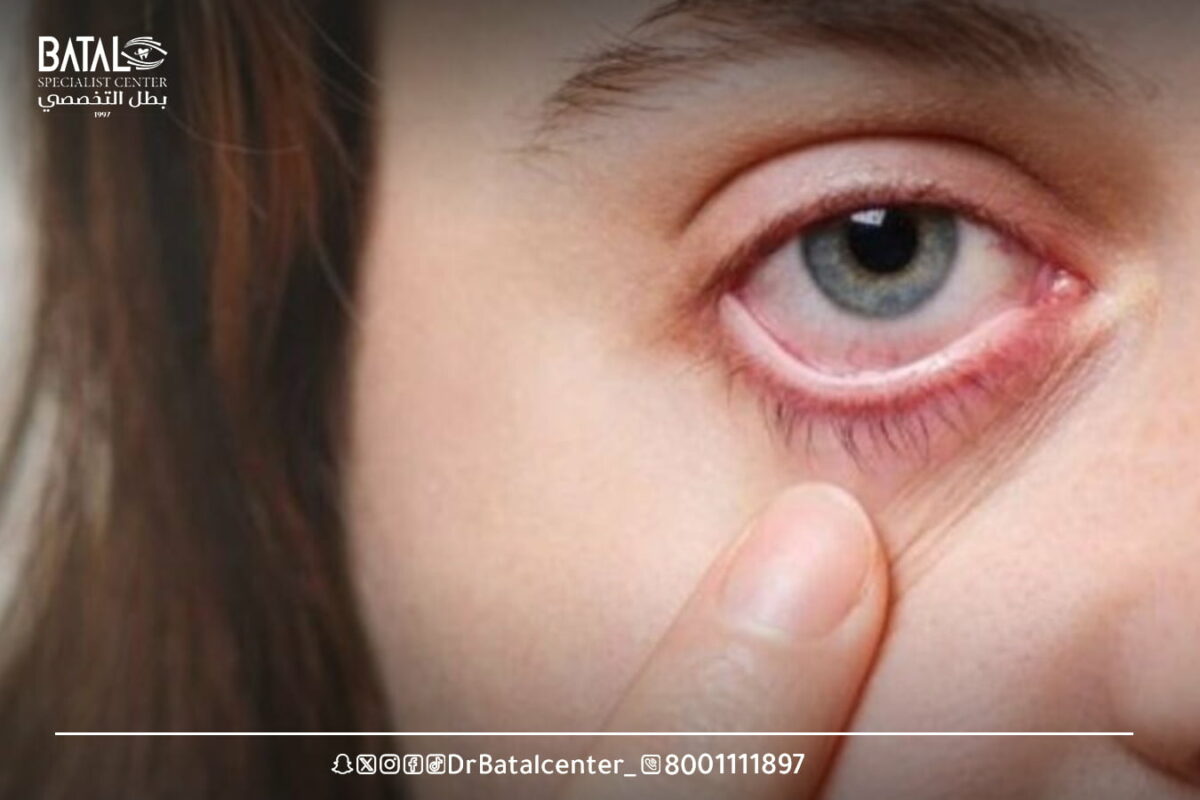 حساسية العين: الأسباب, والانواع, والعلاجات