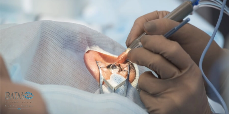 Stages of my experience with strabismus surgery at Batal Specialized Complex