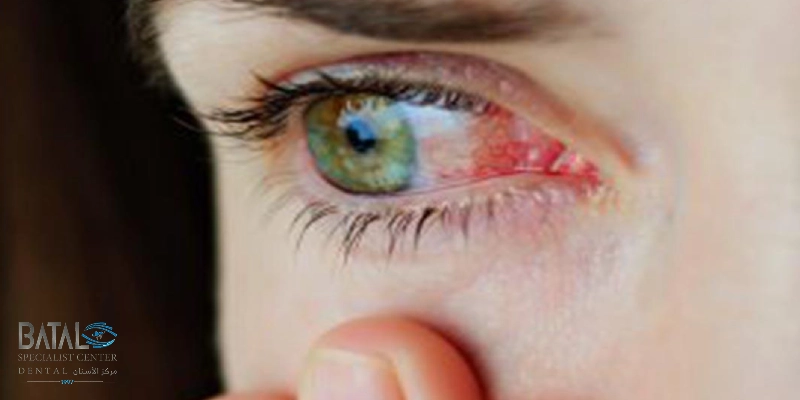 Permanent allergic conjunctivitis