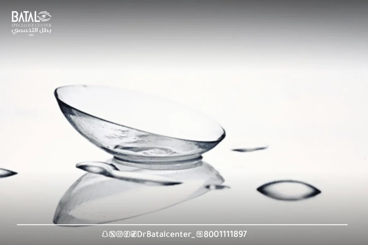 Laser treatment of vision deviation