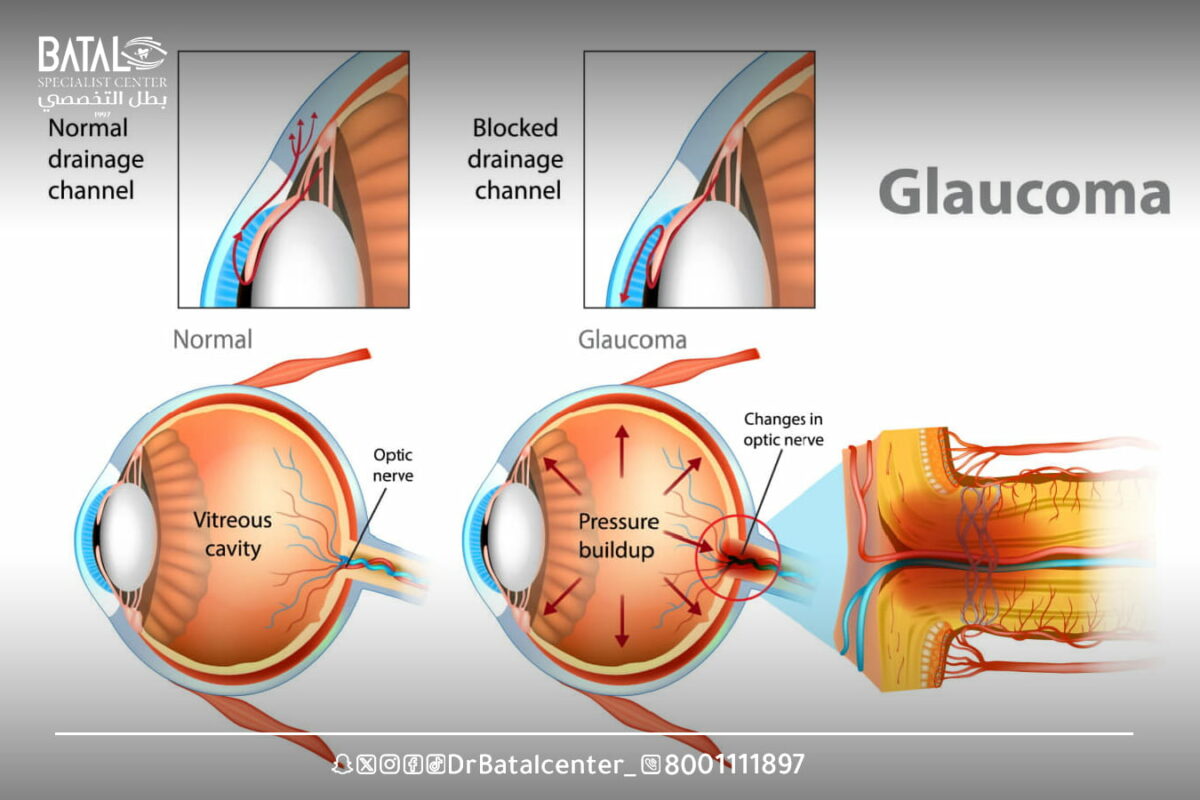 closed-angle glaucoma