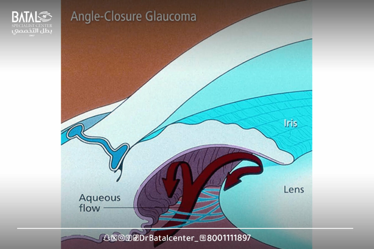 How does a glaucoma patient see?