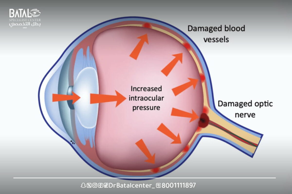 How to diagnose glaucoma at Batal Specialist Complex