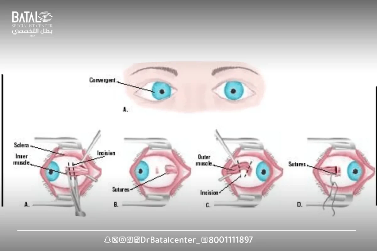 Treatment options for strabismus in children
