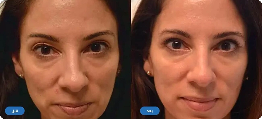 نتائج عملية شد الجفن