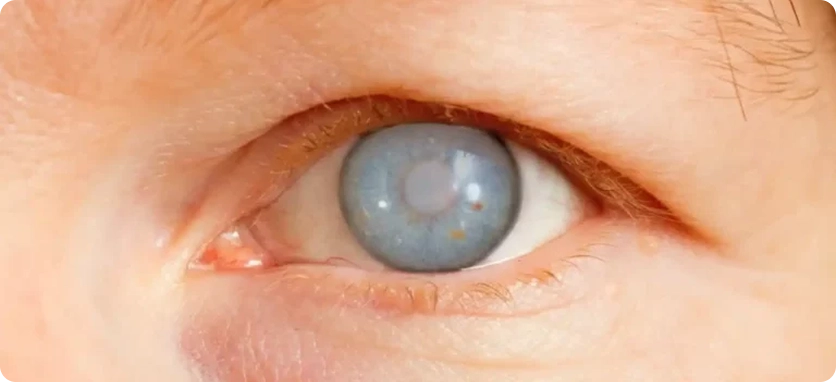 مرض الماء الأزرق في العين