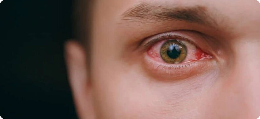 هل أعاني من التهاب بالعين؟