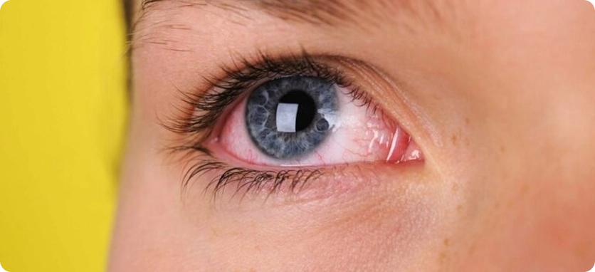 علاج أمراض وجراحة الشبكية | علاج احمرار العين