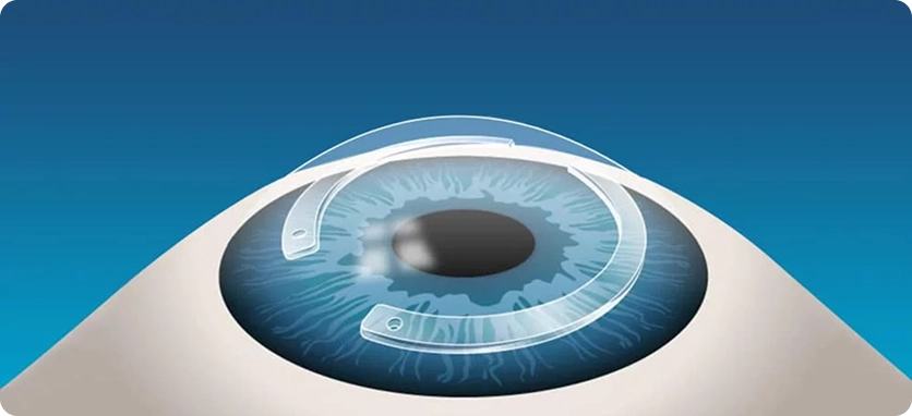 ربط القرنية بالكولاجين