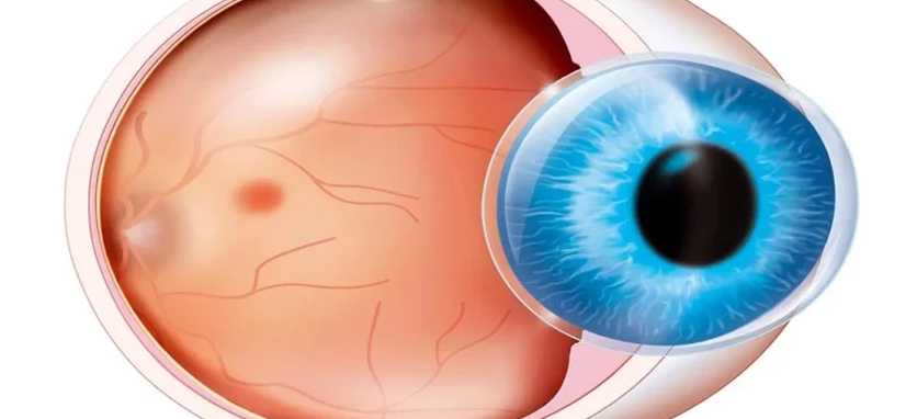 زرع القرنية (رأب القرنية)