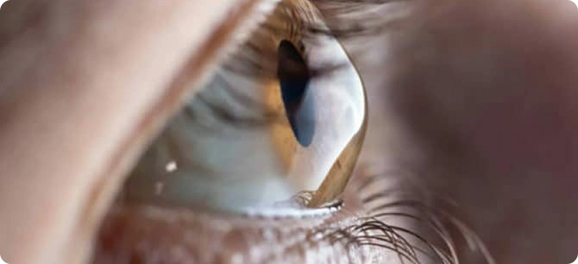 الأقواس INTACS في قرنية العين