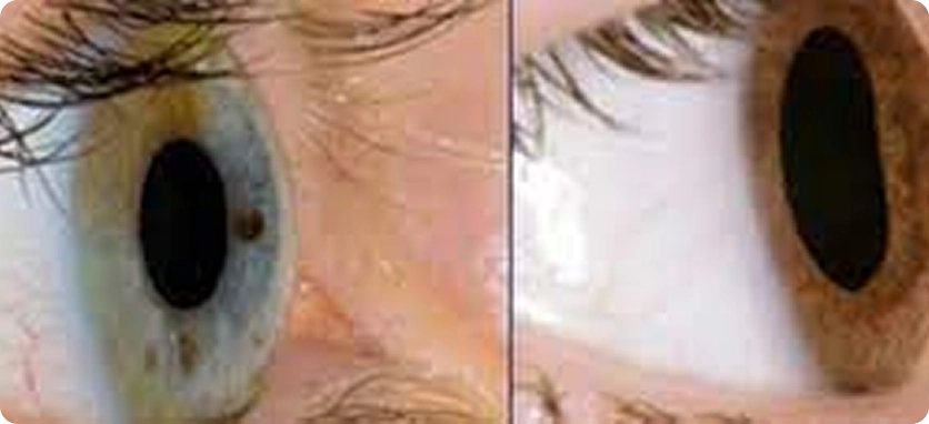 تشخيص القرنية المخروطية في مجمع بطل التخصصي