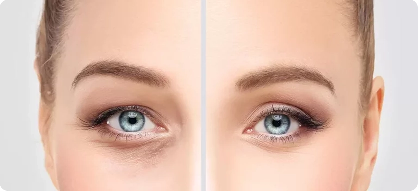 فترة النقاهة والعناية بعد جراحة الجفن