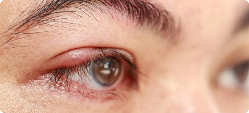 التهاب وانتفاخ العين بسبب انسداد القناة الدمعية