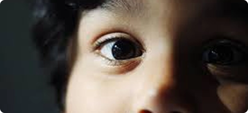 انحراف العين عند الأطفال