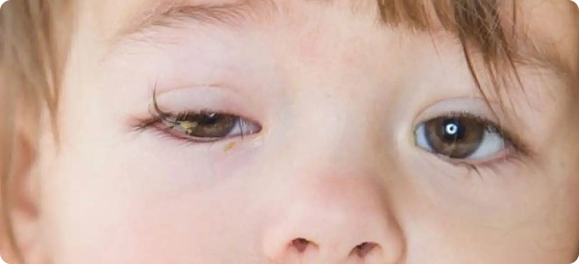 التهاب العين عند الأطفال