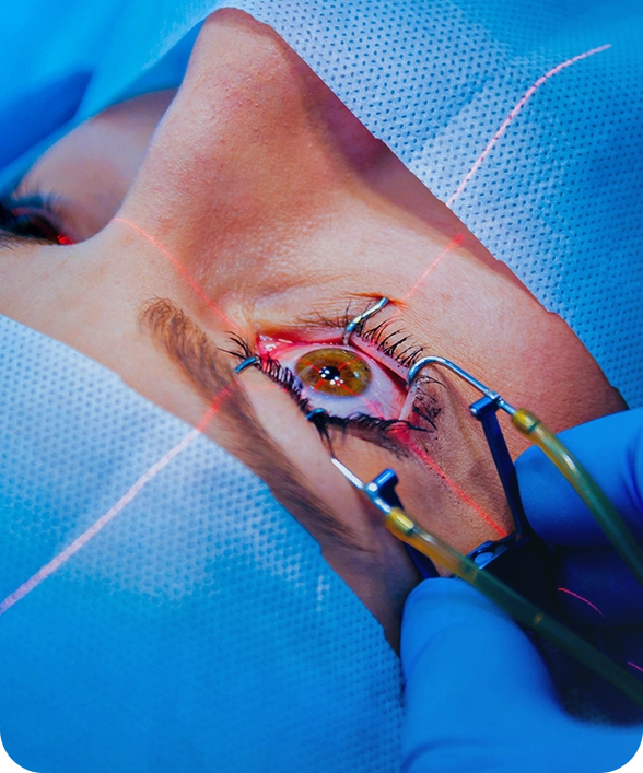 جراحة القرنية المخروطية للعين بالليزك