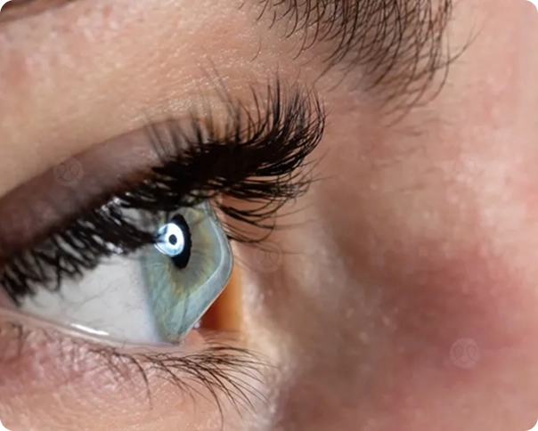 علامات وأعراض القرنية المخروطية