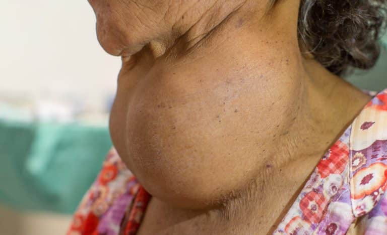 Excessive Goiter Goiter: Thyroid Enlargement Causes, Types, Symptoms & Diagnosis