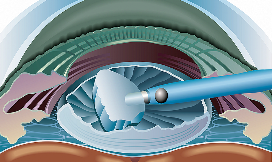 How Is Cataract Surgery Performed?
