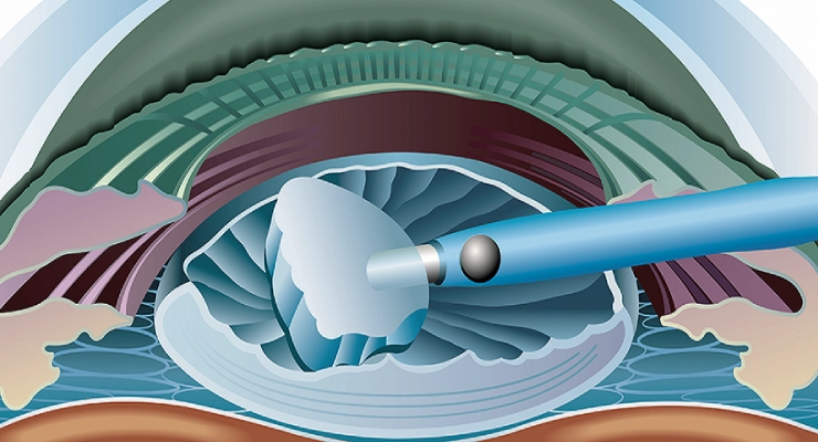 Cataract (Senile Cataract) Surgery by Dr. Mohammed Al‑Mousa