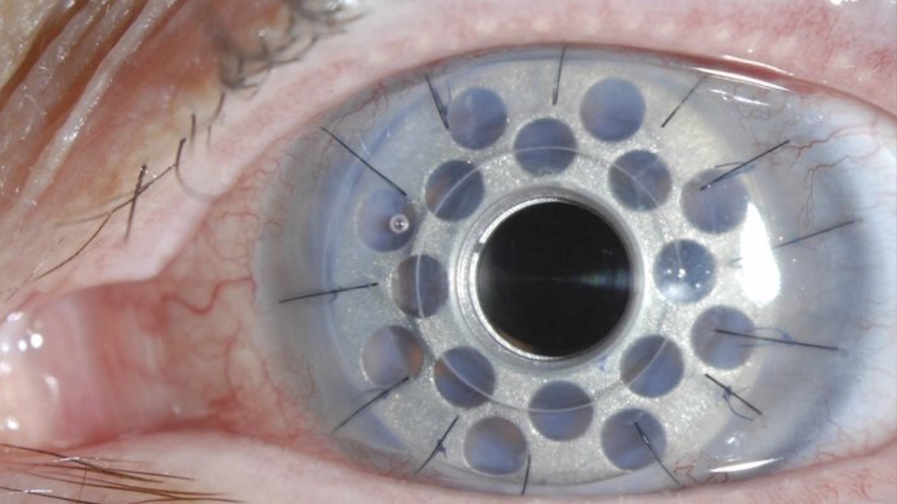 افضل دكتور زراعة قرنية