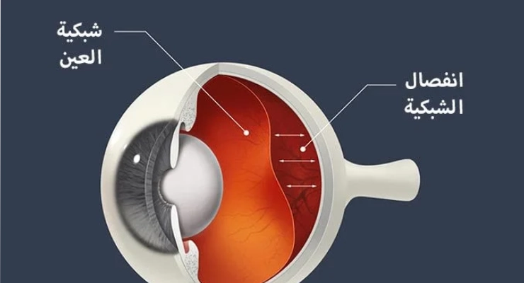 أفضل دكتور جراحة شبكية في جدة